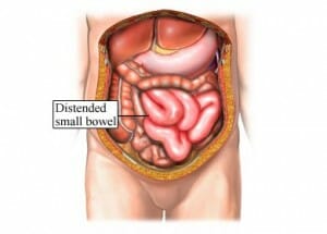 Intestinal Blockage