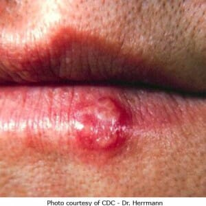 Mouth Herpes 