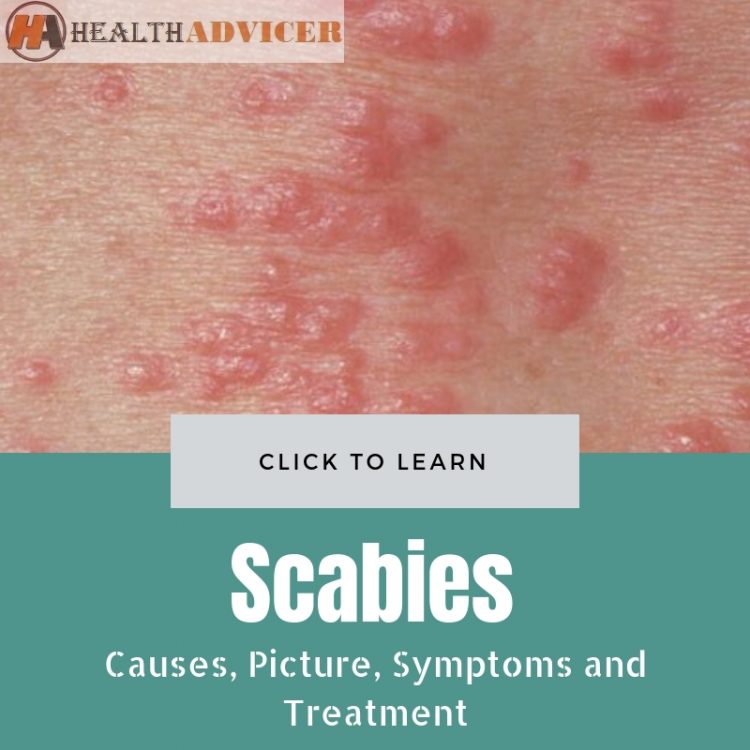 Scabies Causes Picture Symptoms And Treatment