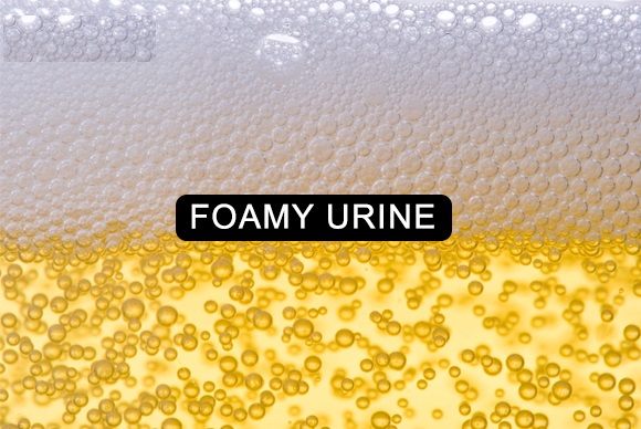 Foamy Urine bubbles