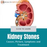 Kidney Stones Pictures