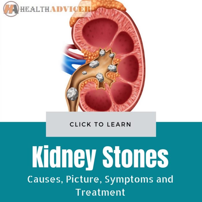 Kidney Stones Pictures