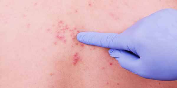 HIV Skin rashes symptoms