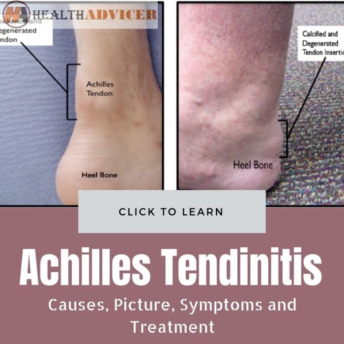 Achilles Tendinitis Causes and treatment