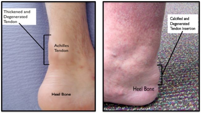 Achilles Tendinitis affected legs