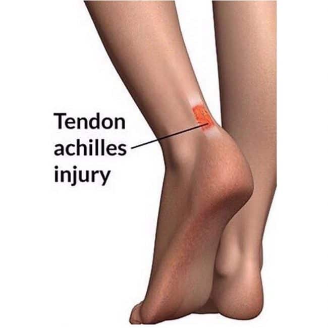 Achilles Tendinitis injury