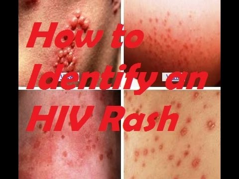 Symptoms of HIV rash