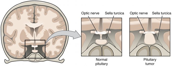 Pituitary adenoma