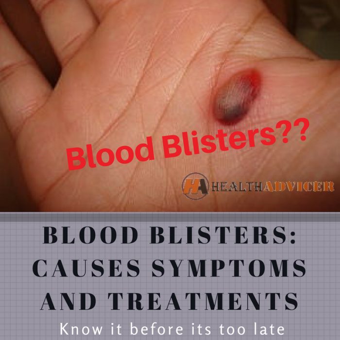 Blood Blisters