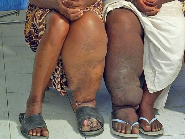 Elephantiasis