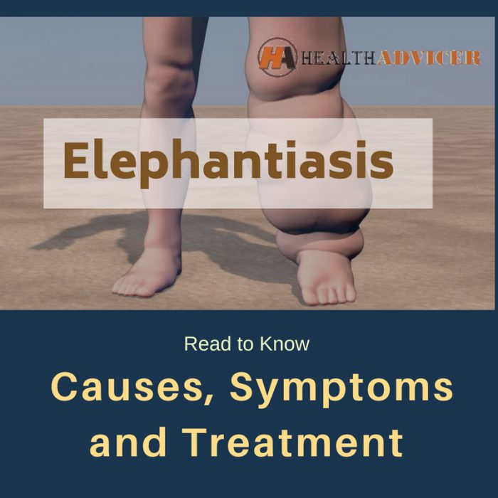 Elephantiasis