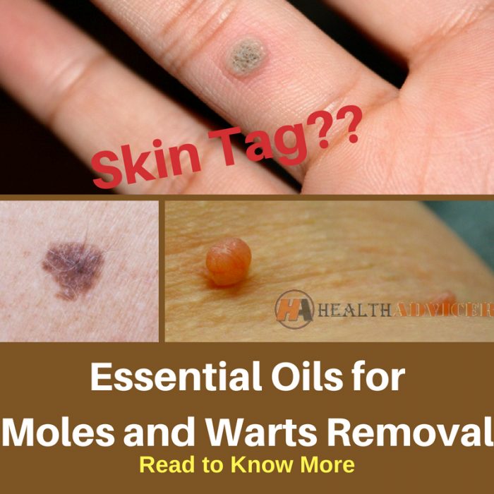 Essential Oils for Moles and Warts Removal