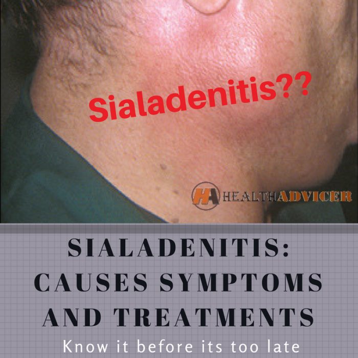 Sialadenitis