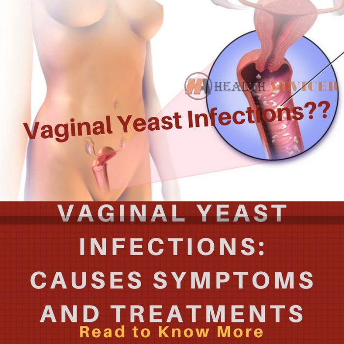 Vaginal Yeast Infections