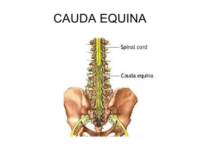 cauda-equina-syndrome