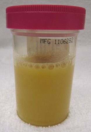 protein in urine