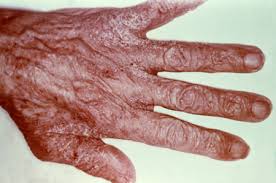 scabies infected hand