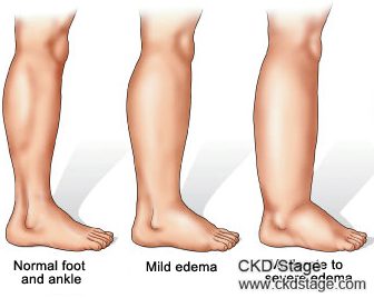 kidney swelling