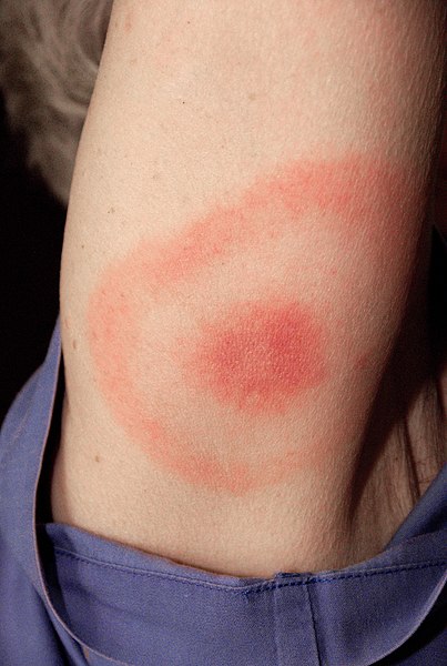 Appearance Of Erythema Marginatum