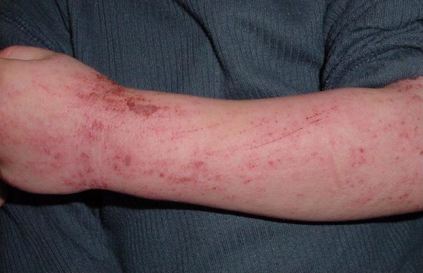 Eczema