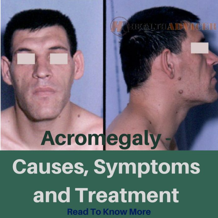 Acromegaly