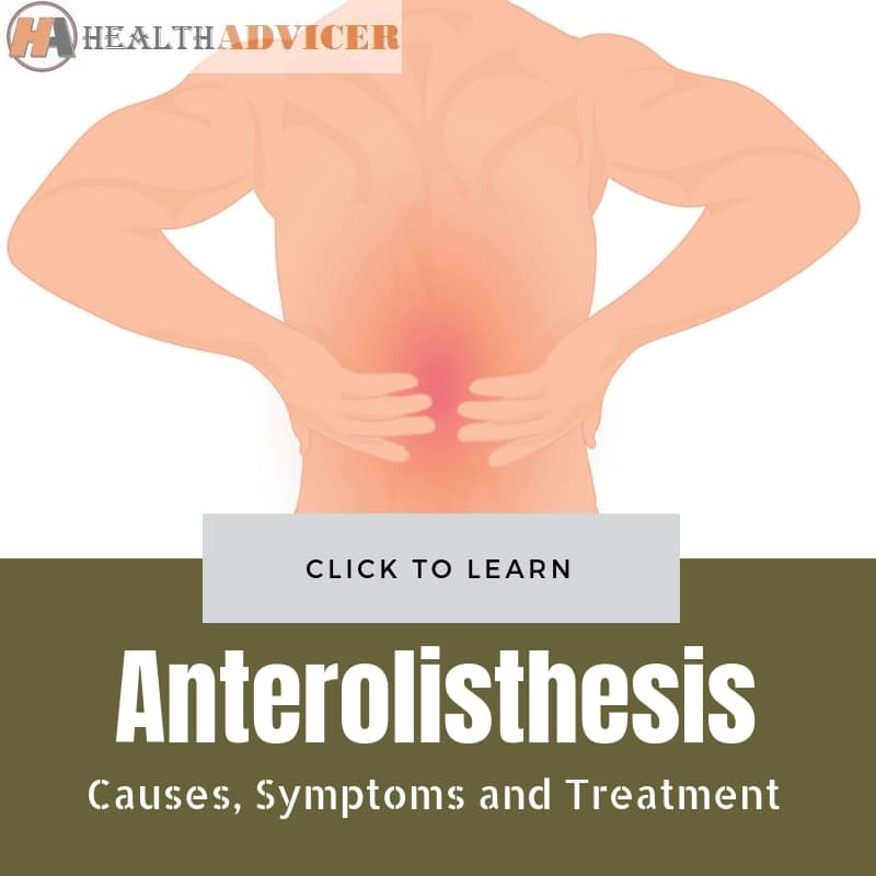 Anterolisthesis Causes treatment