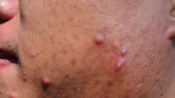 Cystic_acne