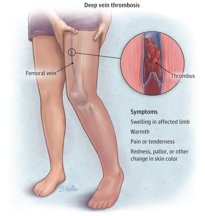 Deep Vein Thrombosis