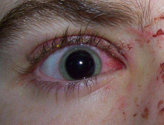 Eye Trauma