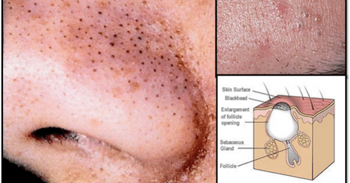 blackheads