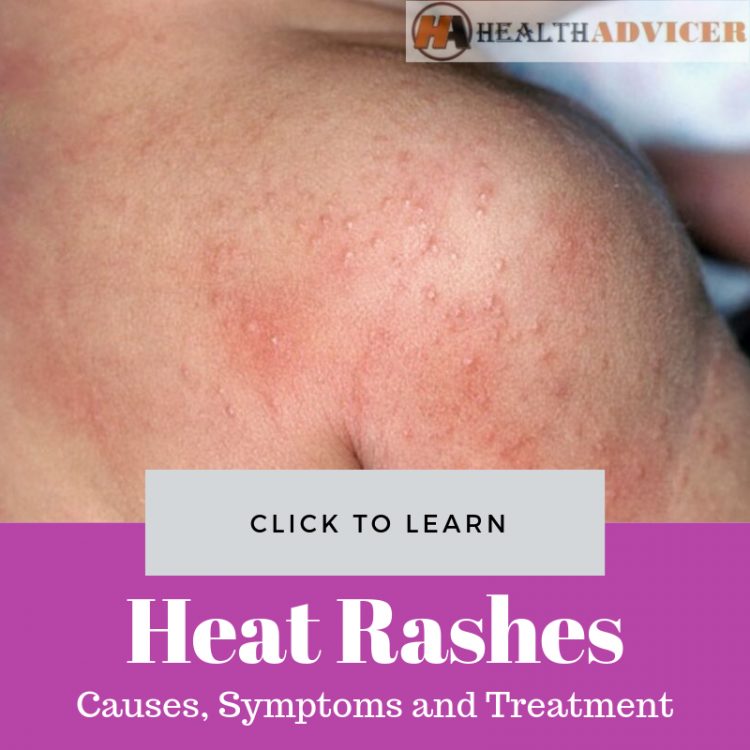 Heat Rashes Causes Picture Symptoms Treatment And Prevention