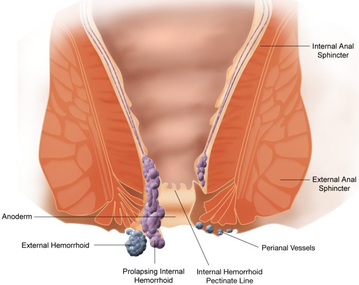 hemorrhoide