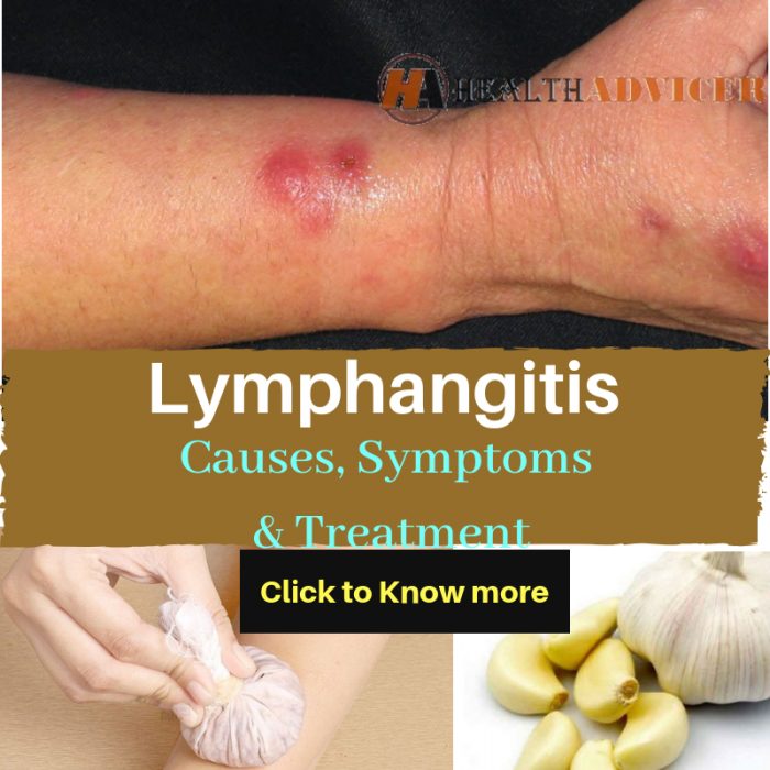 Lymphangitis