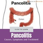 Pancolitis Causes Treatment