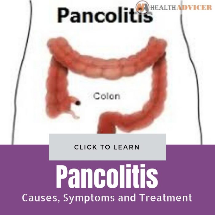 Pancolitis Causes Treatment