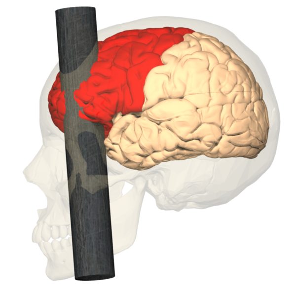 frontal lobe stroke case study