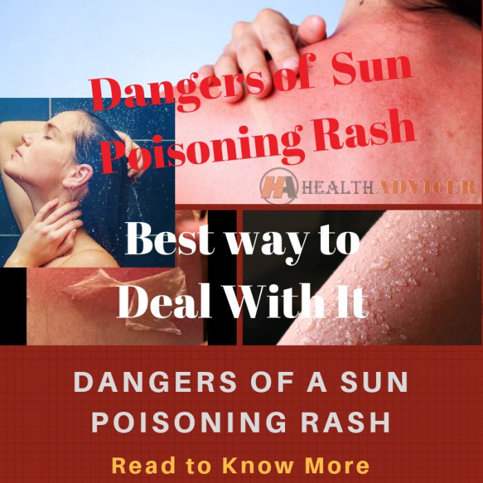 Sun Poisoning Rash