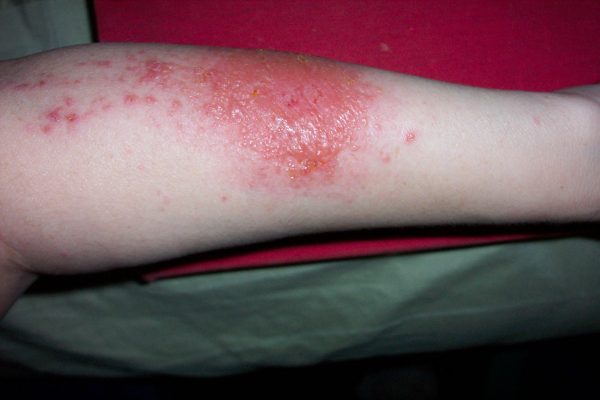 Contact Dermatitis