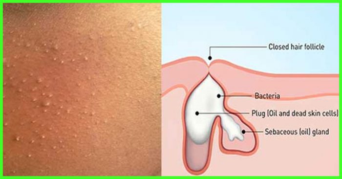 Whiteheads-On-Face-And-Nose