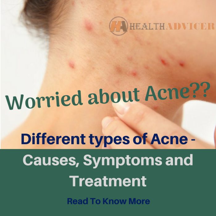 Acne : Causes, Pictures, Symptoms And Treatment