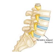 Anterolisthesis