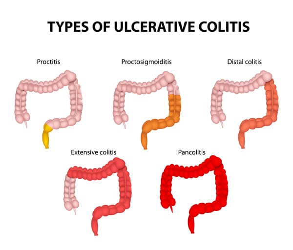 Type of ulcerative