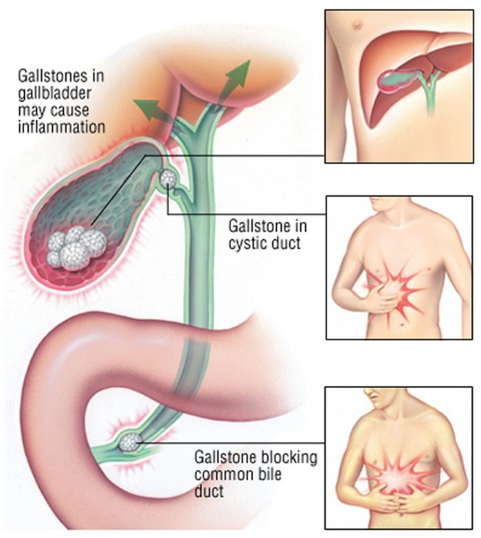 biliary colic