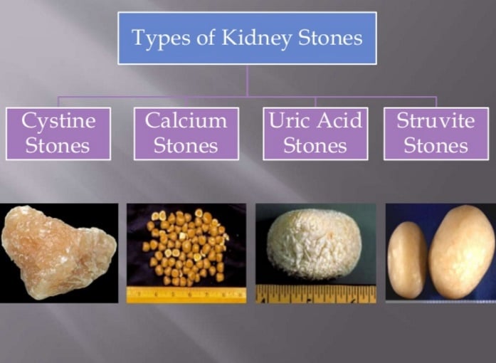 kidney-stones