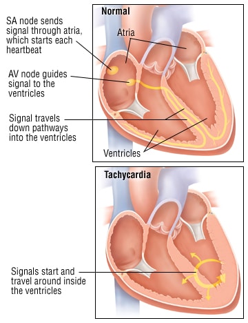 Tachycardia