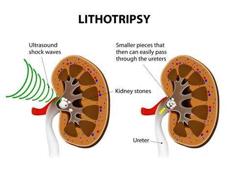 litotripsy