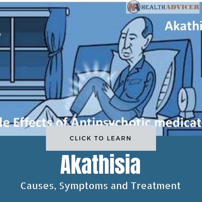 Akathisia Causes Treatment