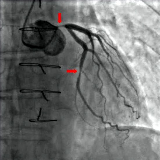 Angiogram