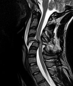 Neurogenic Shock