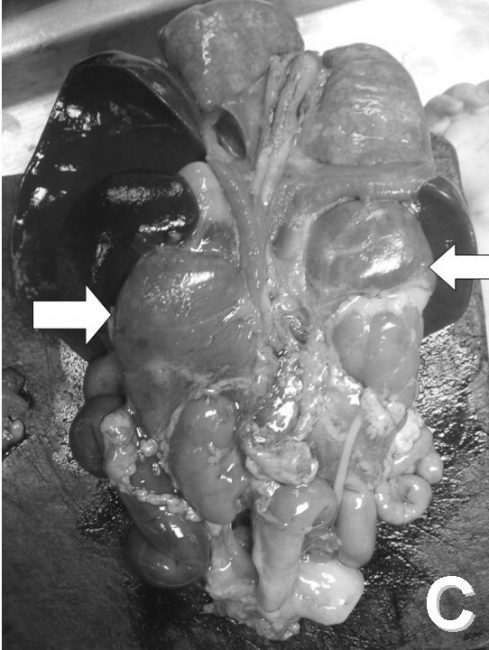 Congenital Adrenal Hyperplasia